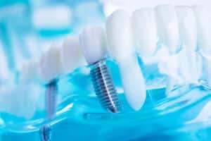 The Benefits of Dental Implants