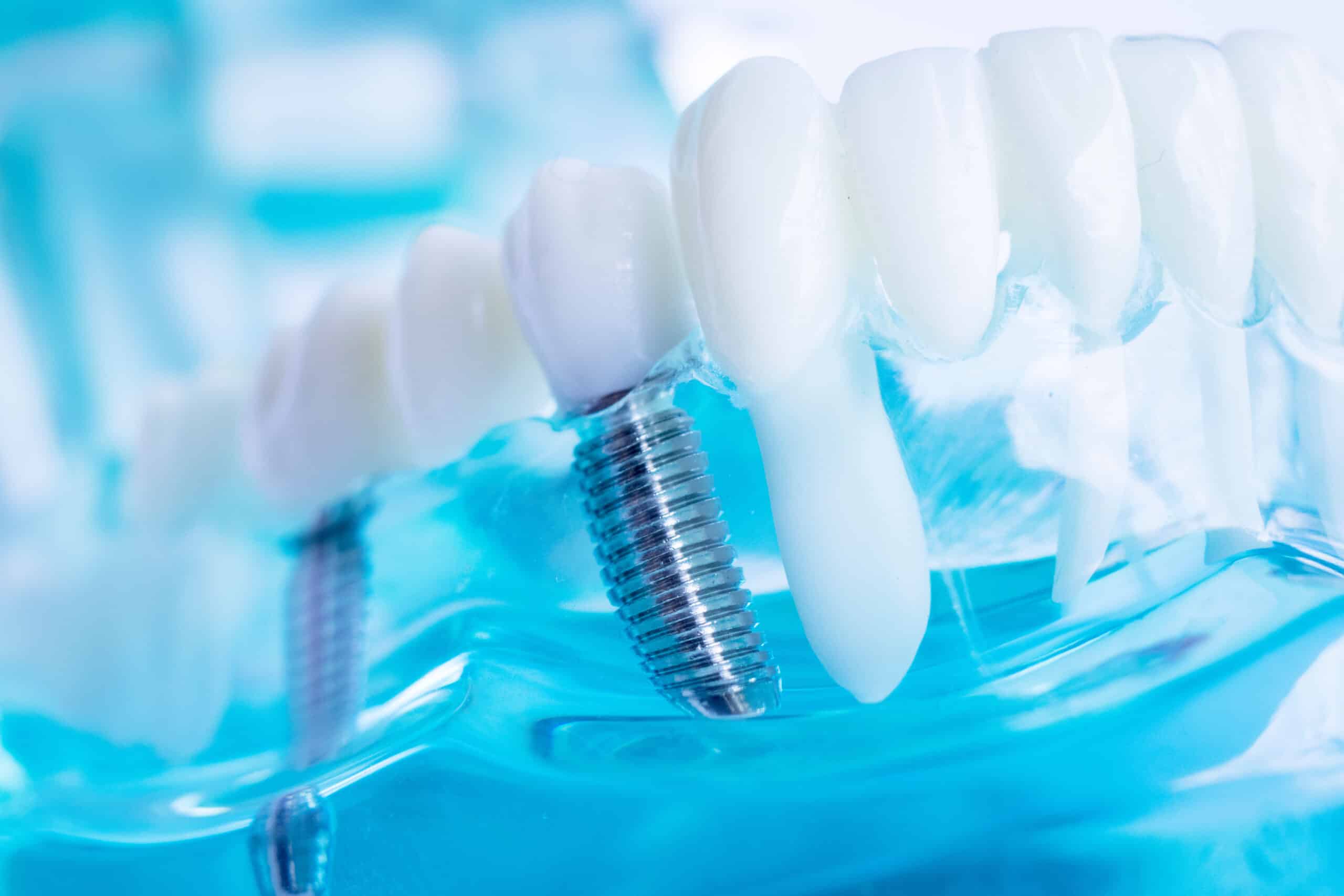 The Benefits of Dental Implants